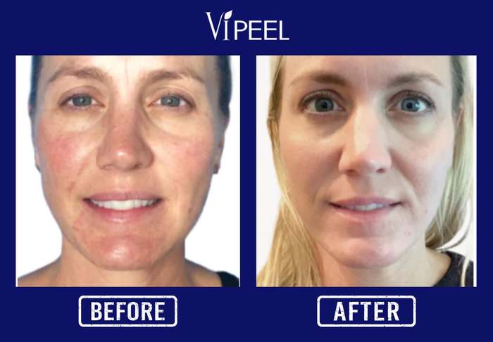 vi peel before after